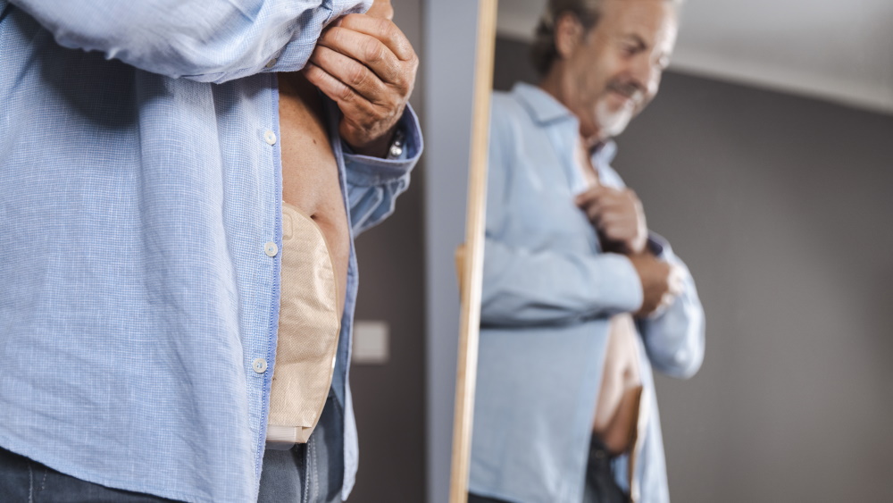 A middle-aged man with a stoma bag attached is standing in front of a mirror, buttoning his shirt