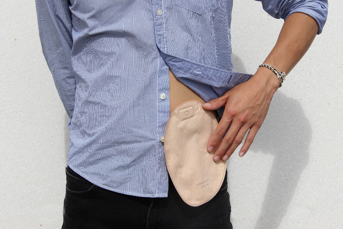hand is holding attached stoma bag 