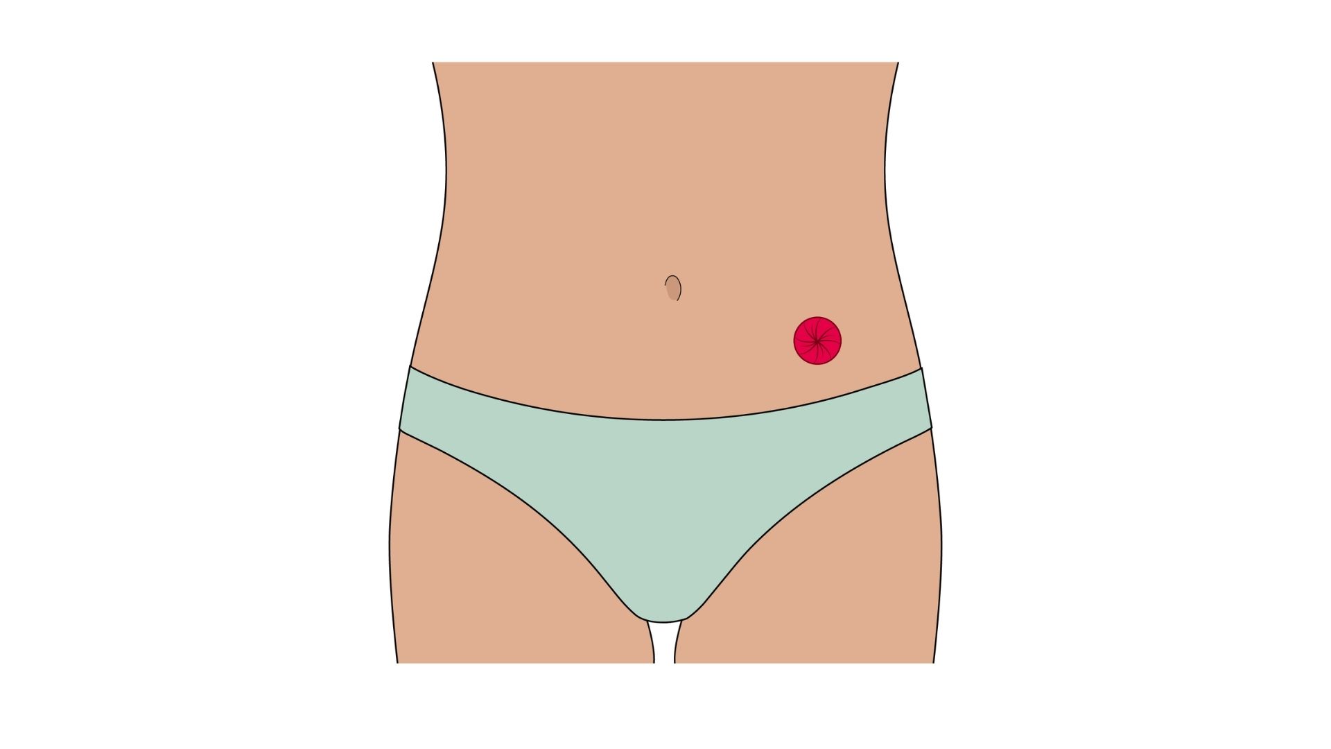  An anatomical illustration showing the  view of a colostomy, highlighting how the stoma (represented in red) connects the descending colon directly to the abdominal wall, with the bypassed lower portion of the bowel faded out.