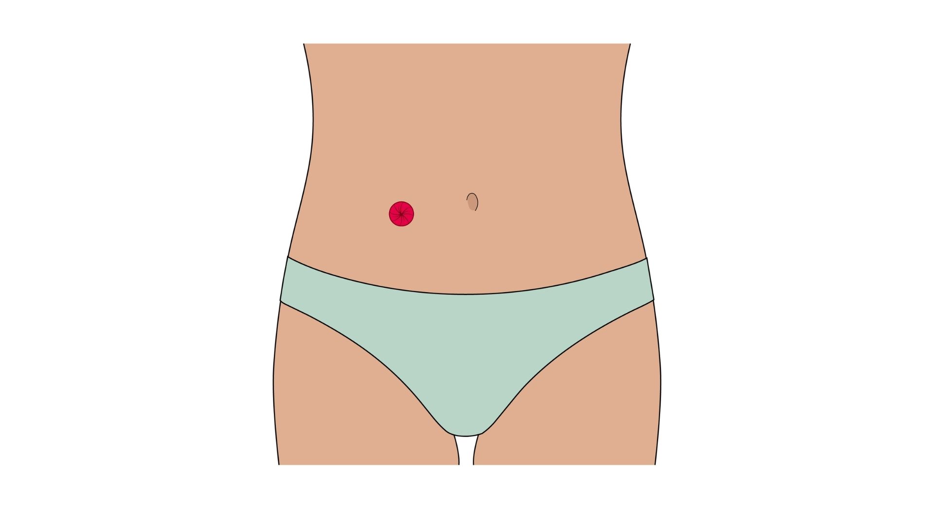  An anatomical illustration showing the  view of an ileostomy, highlighting how the stoma (represented in red) connects the small intestine (ileum) directly to the abdominal wall, with the entire large intestine faded out.