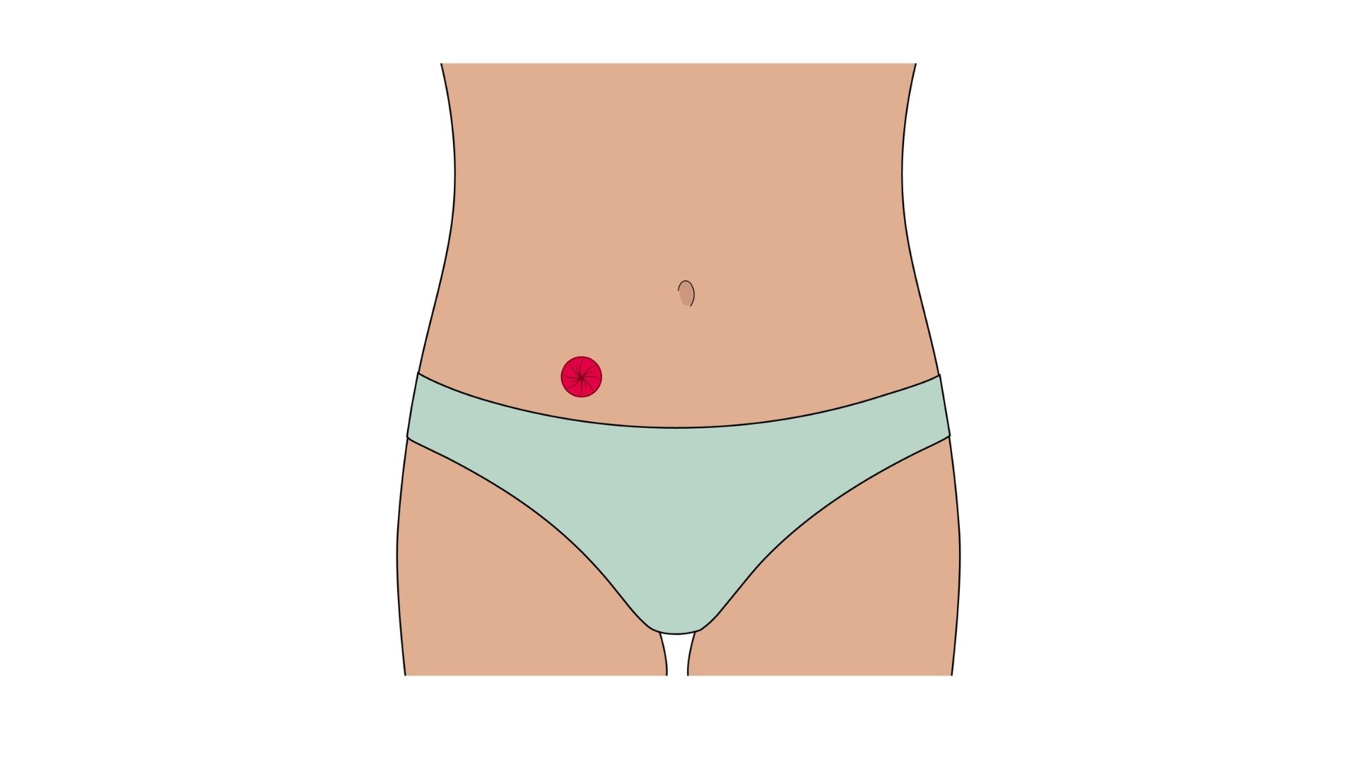 An anatomical illustration showing the view of a urostomy, highlighting the two kidneys and ureters connected to an isolated bowel segment (ileal conduit) that creates the stoma, represented in red on the abdominal wall, with the digestive tract faded out.