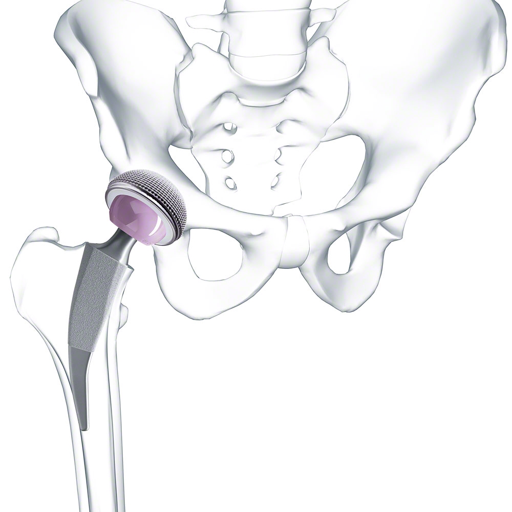 Metha® Short Hip Stem