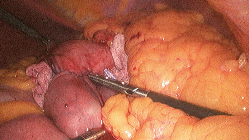 Laparoscopic Roux-en-Y gastric bypass: Indigo carmine test following gastrojejunostomy