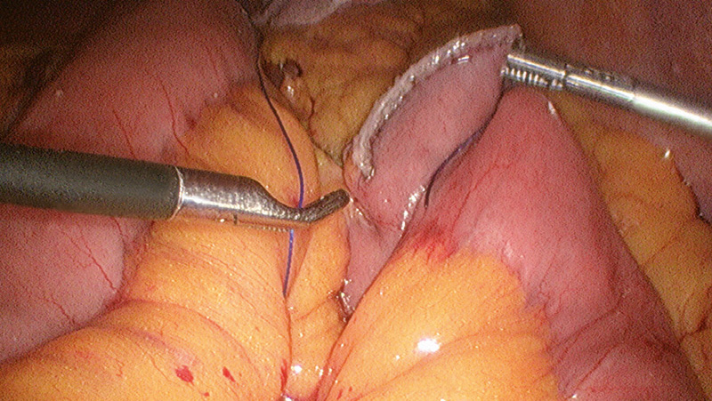 Laparoscopic Roux-en-Y gastric bypass: Closure of the mesocolon opening after stapling of the jejunojejunostomy