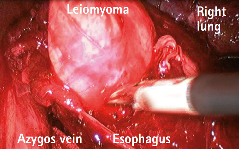 Intrathoracic site for the enucleation of a large esophageal leiomyoma
