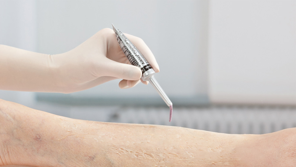 Askina Calgitrol Paste little 15g tube held in a hand in examination gloves being applied on a human leg